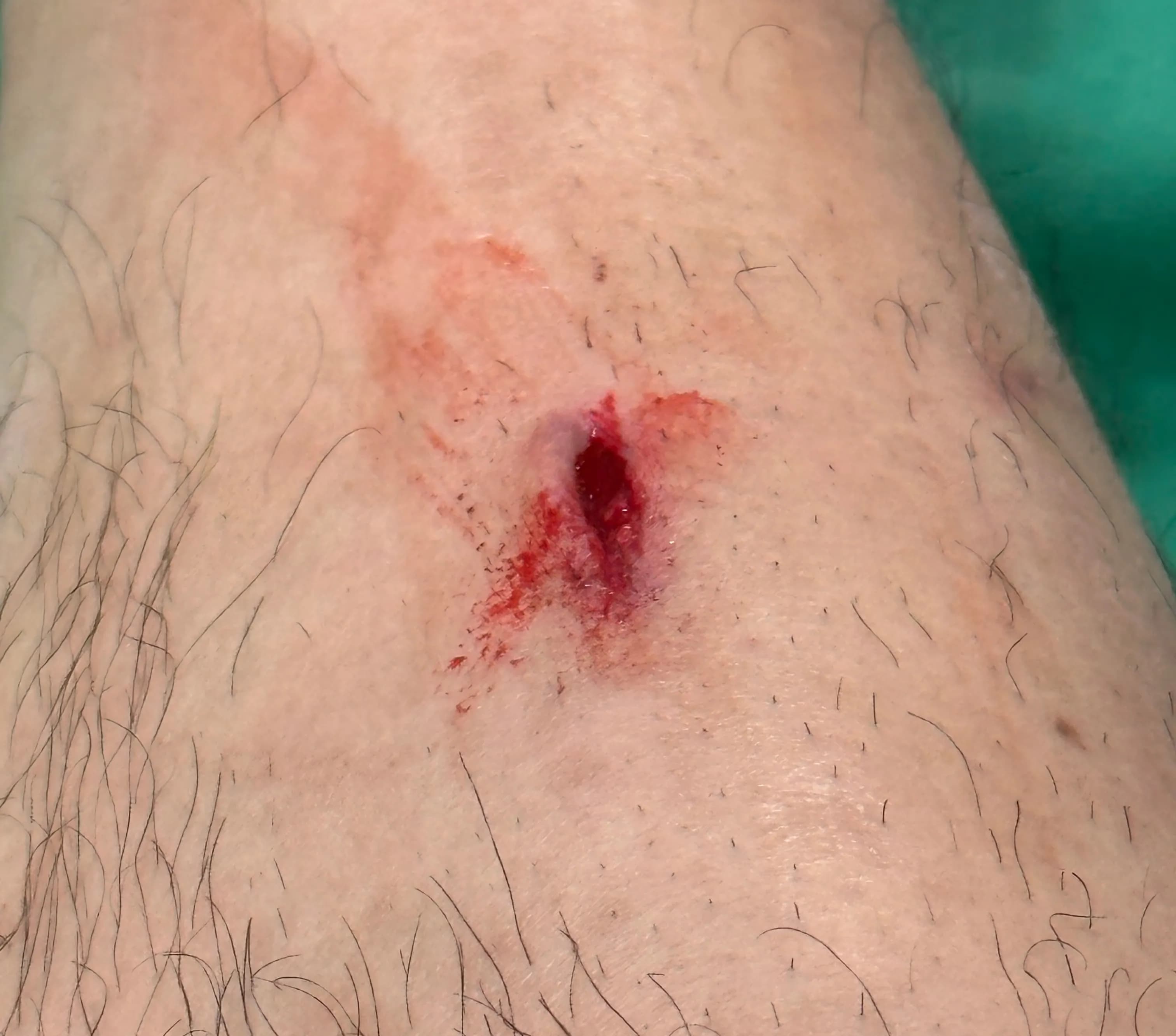 サンゲ・ベク病院救急外来の口コミ - 縫合の基準、ドレッシングの方法、縫った傷の回復期間-8