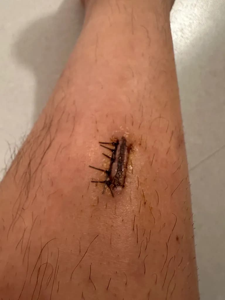 상계 백병원 응급실 후기 - 상처 꿰매는 기준, 드레싱 방법, 꿰맨 상처 회복 기간-17