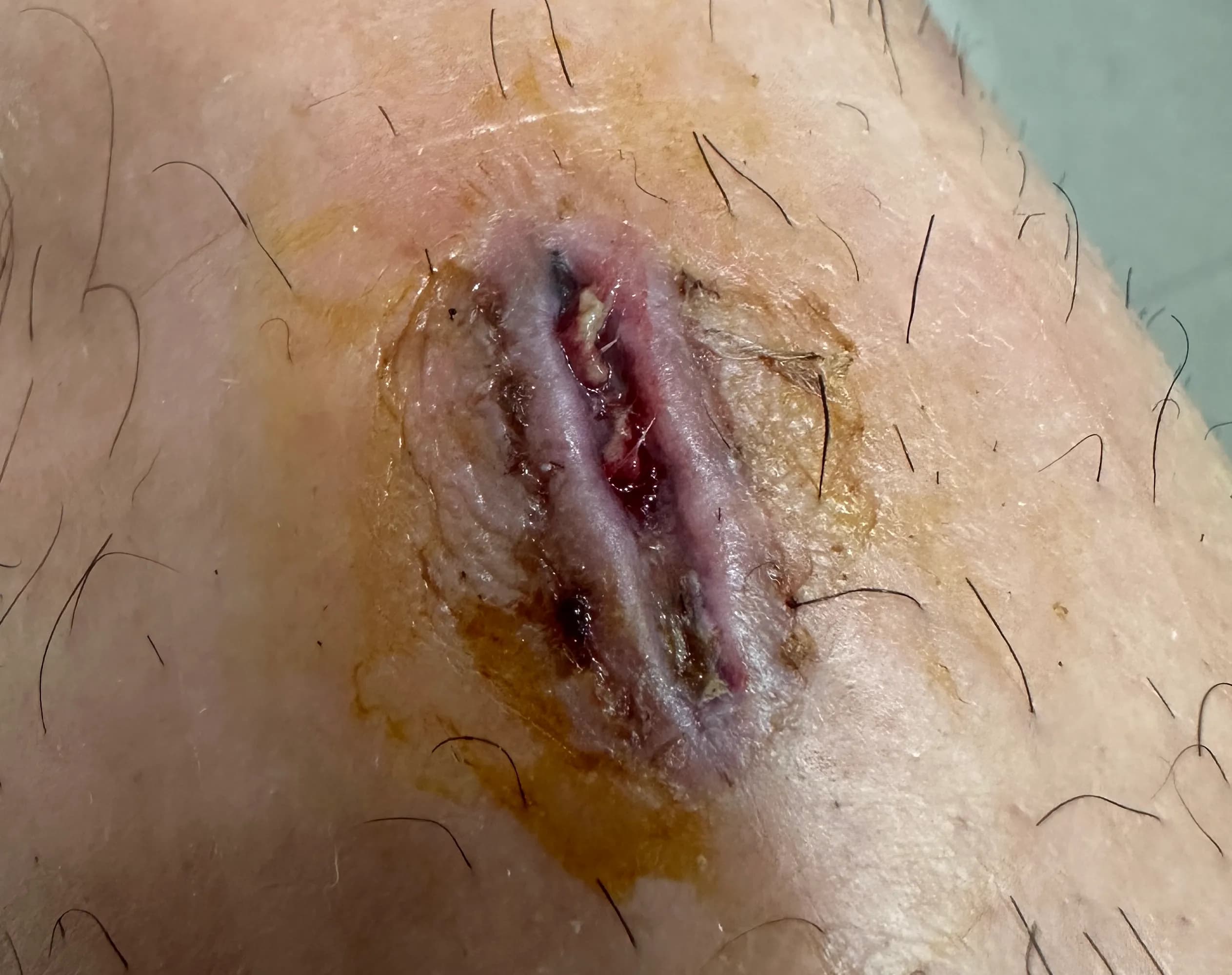 상계 백병원 응급실 후기 - 상처 꿰매는 기준, 드레싱 방법, 꿰맨 상처 회복 기간-22