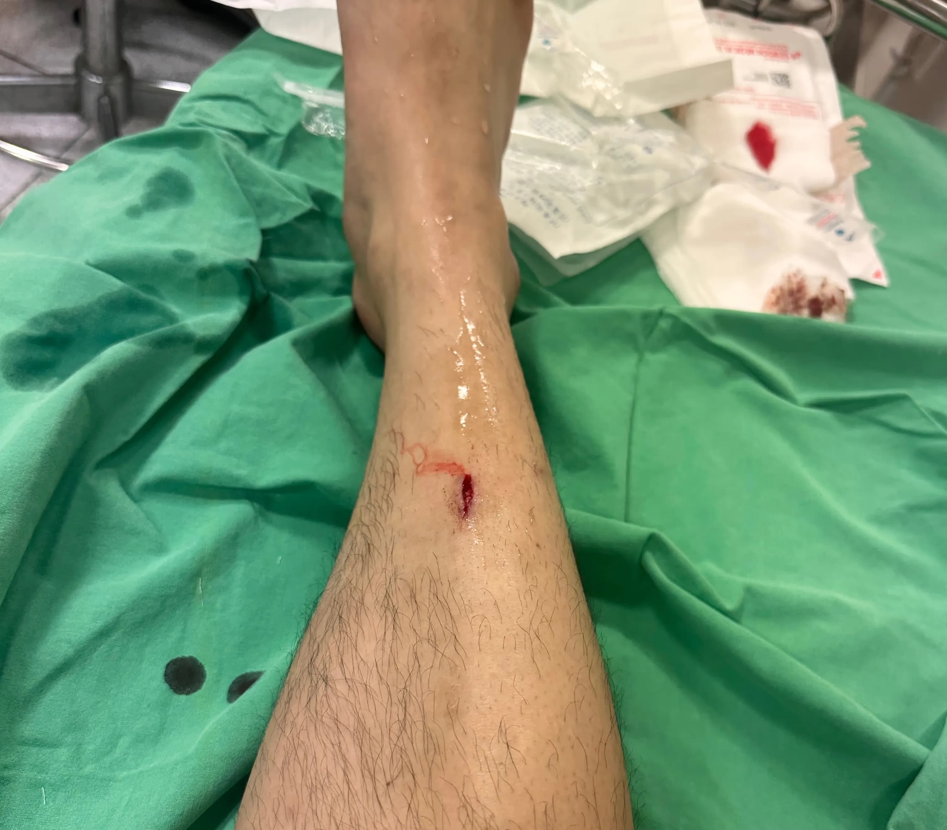 サンゲ・ベク病院救急外来の口コミ - 縫合の基準、ドレッシングの方法、縫った傷の回復期間-9