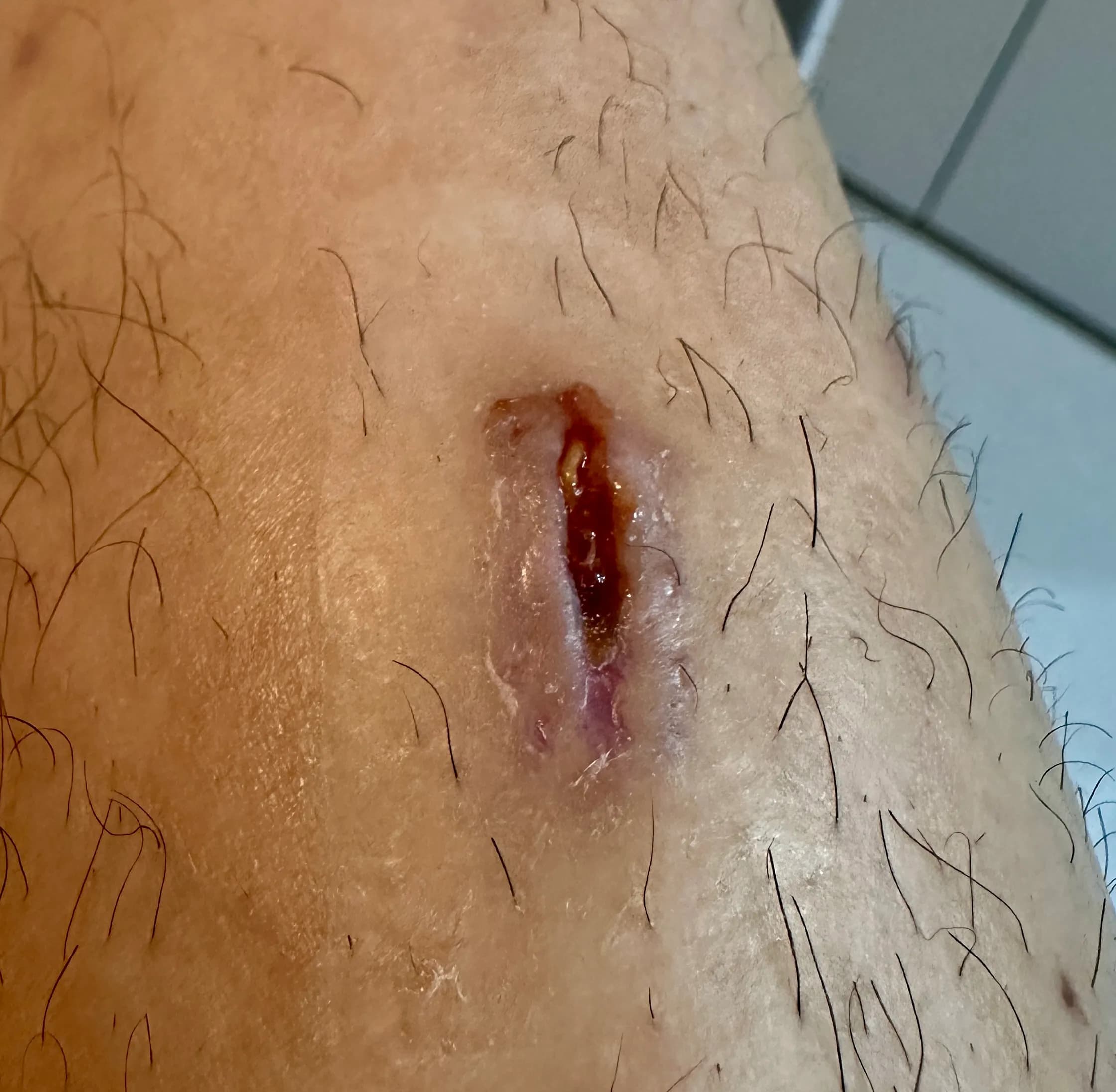 상계 백병원 응급실 후기 - 상처 꿰매는 기준, 드레싱 방법, 꿰맨 상처 회복 기간-23