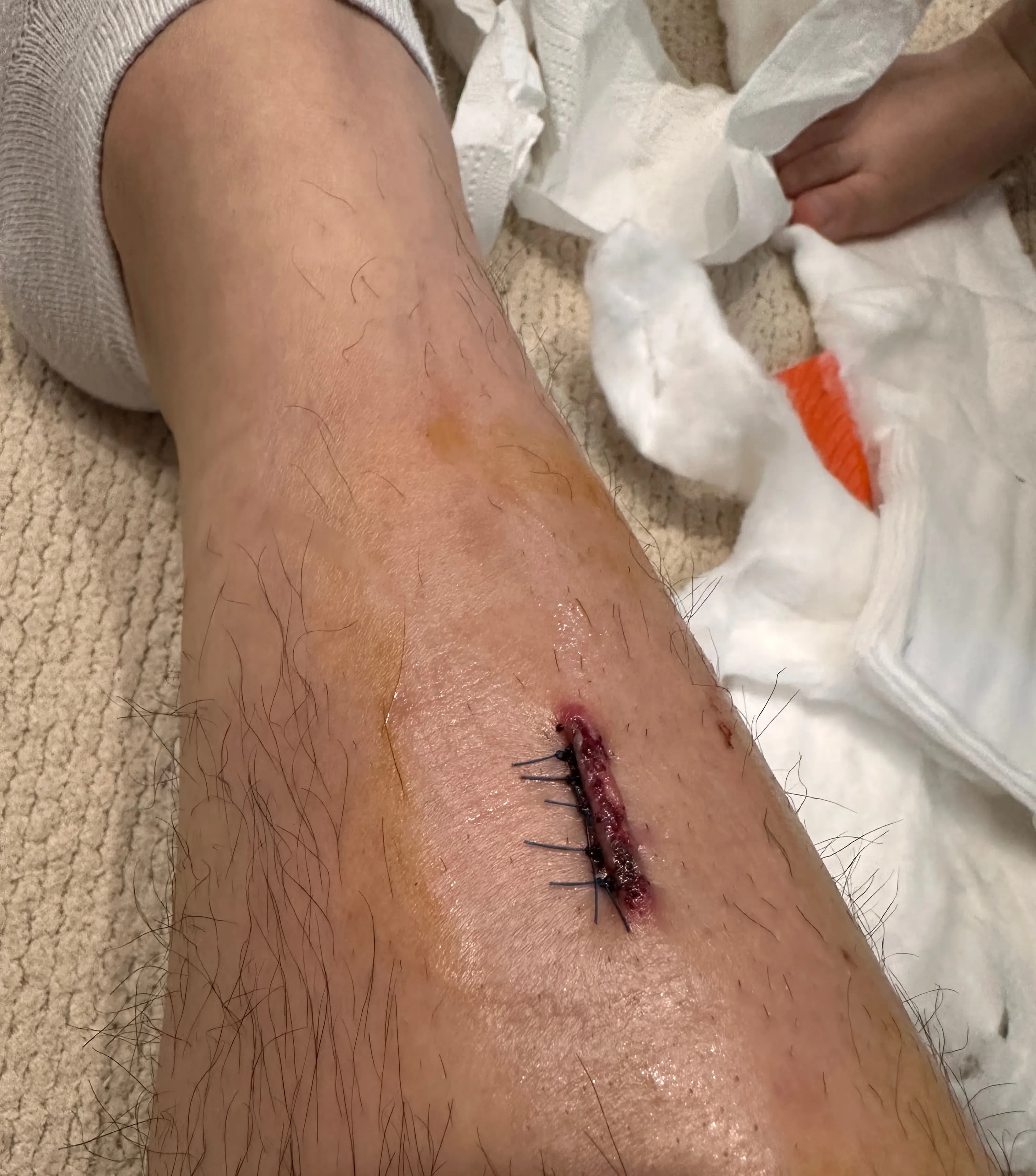 サンゲ・ベク病院救急外来の口コミ - 縫合の基準、ドレッシングの方法、縫った傷の回復期間-15