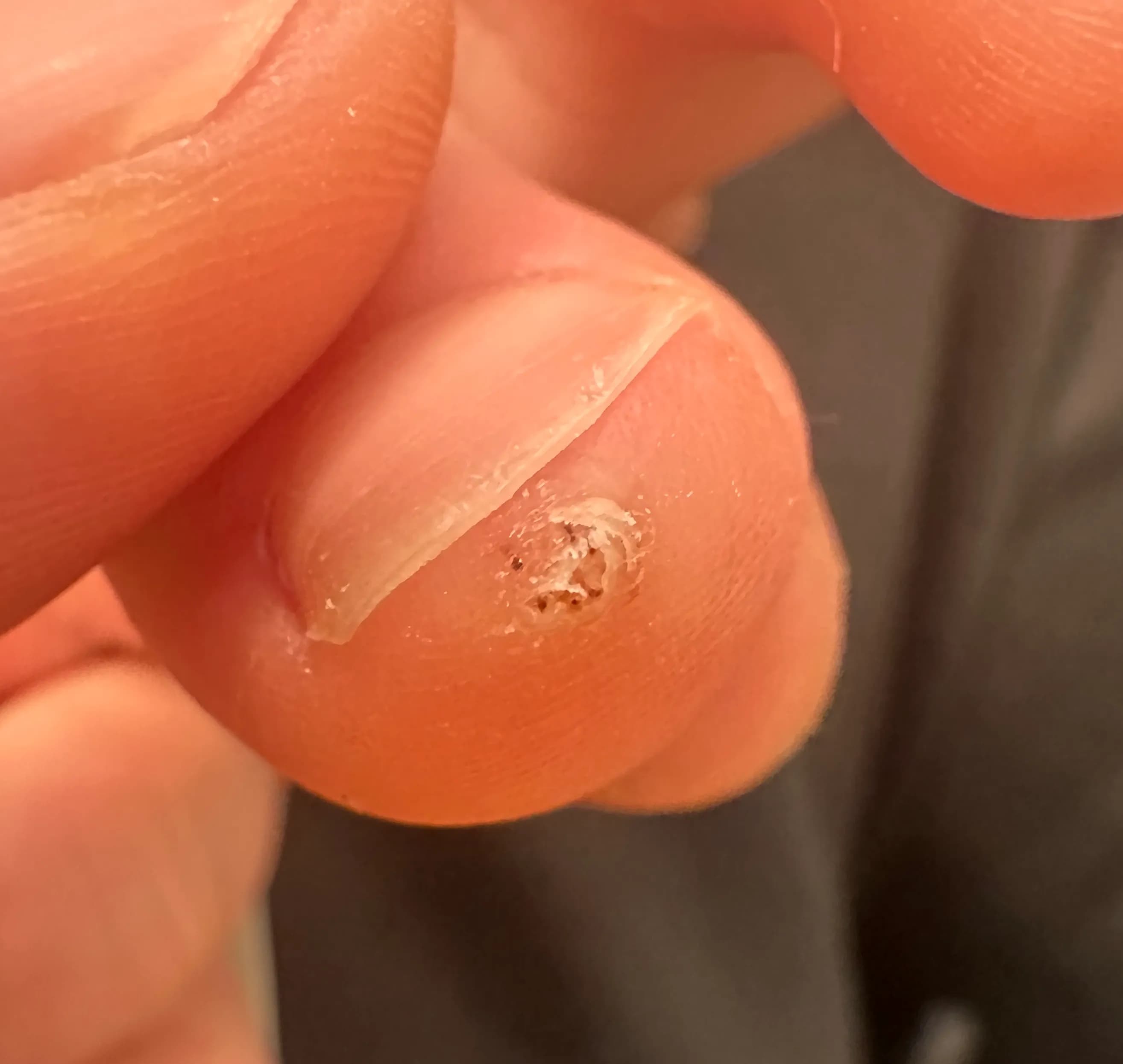 만4세 아기 발가락 사마귀 제거 후기-1