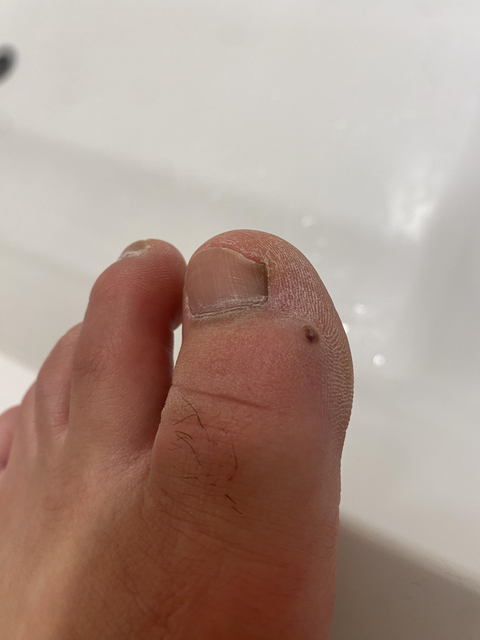 발가락에 난 물혹 - 결절종 짜보기-17